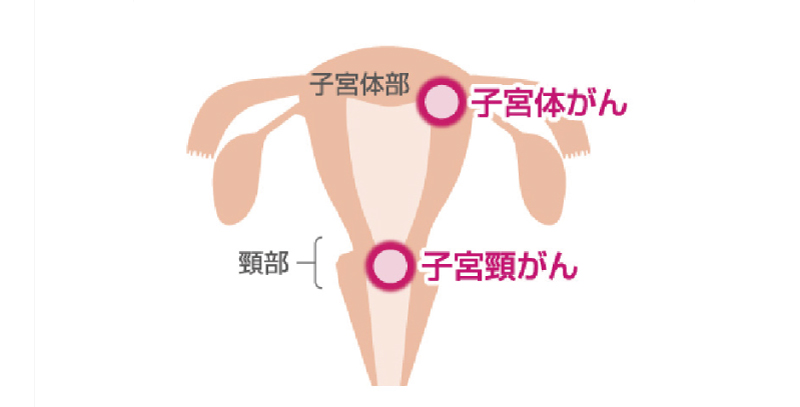 子宮頸がんワクチン接種勧奨の再開　島根大医学部京教授 副作用での不安軽減策も